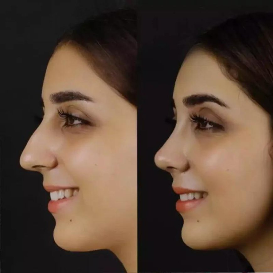 Dorsal Hump Reduction: Smoothing Out the Bridge of the Nose for a Straighter Profile