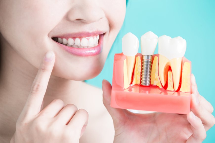 Restoring Smiles: The Advantages of 4 on 4 Dental Implants