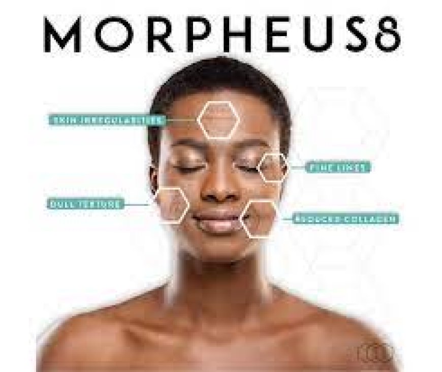 What is Morpheus8? A Comprehensive Guide
