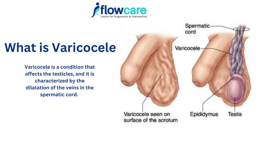 Understanding Varicocele and Effective Treatment Options with FlowCare