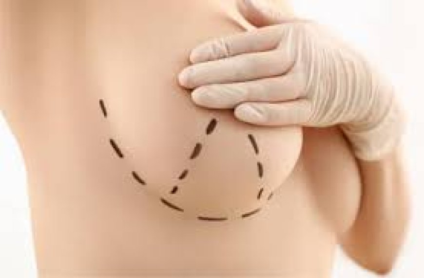 Common Myths About Breast Lift Debunked