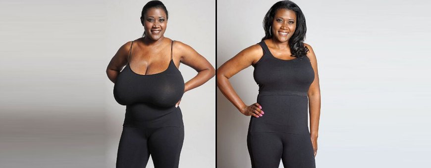 How Breast Reduction Surgery Has Evolved Over the Years