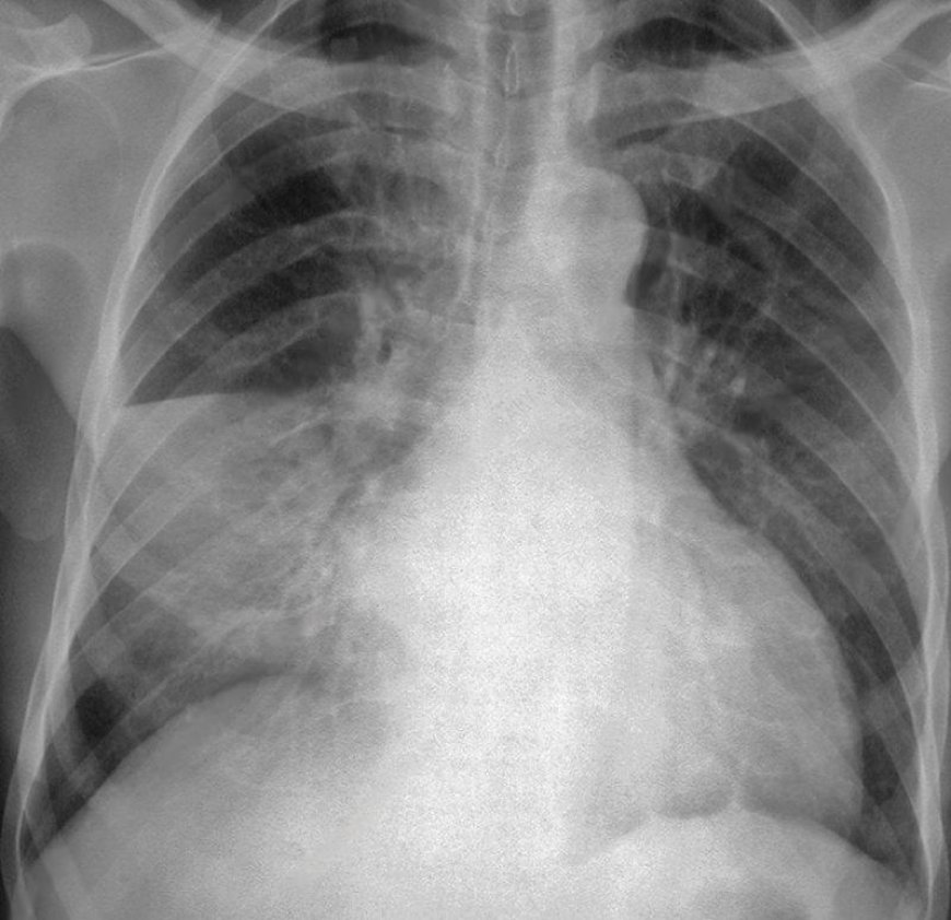 Azithromycin for Pneumonia