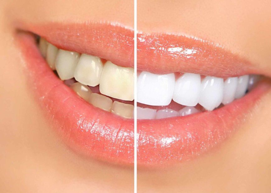 How to Maintain Your Teeth Whitening Results