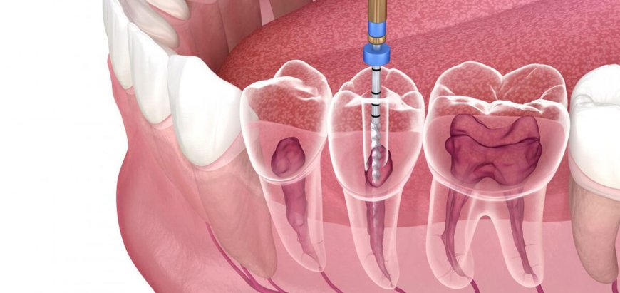 What Causes a Tooth to Need a Root Canal?