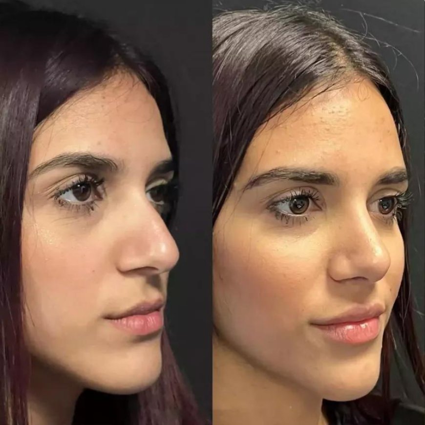 Rhinoplasty and Eye Aesthetics: Enhancing Facial Harmony in Dubai