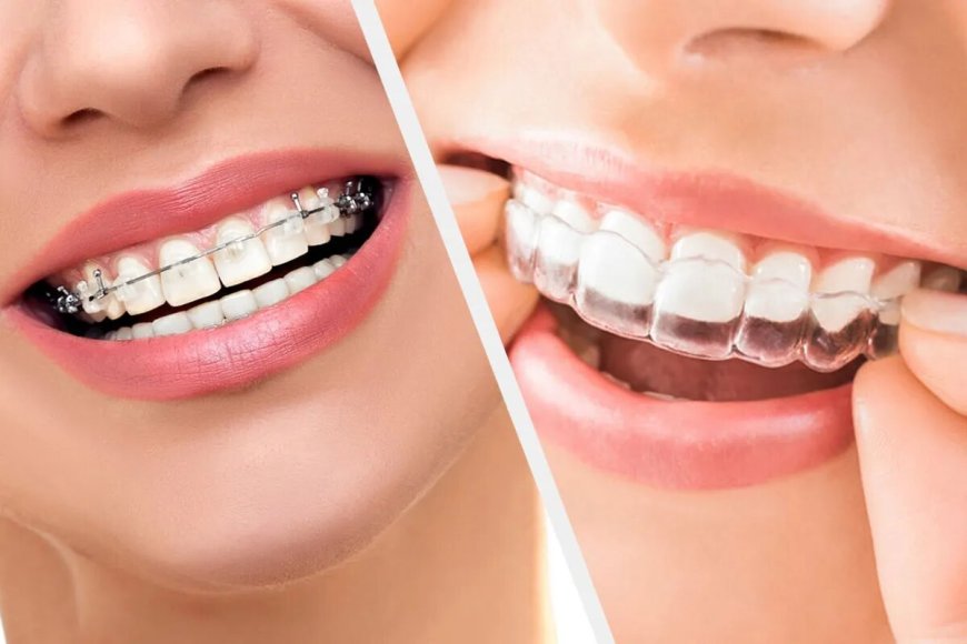 The Benefits of Invisalign Over Traditional Braces