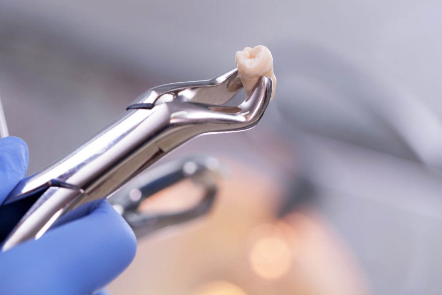 The Essential Guide to Tooth Extractions: Benefits and Aftercare