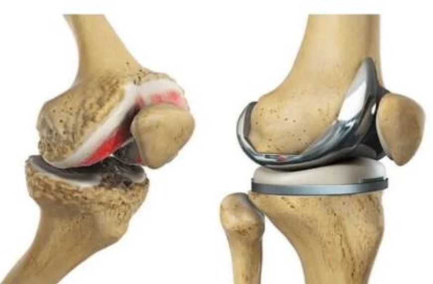 The Importance of Choosing the Right Knee Replacement Surgeon in Kolkata