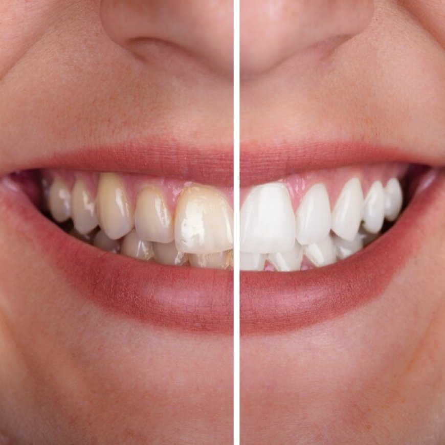 Brighten Your Smile with Professional Teeth Whitening