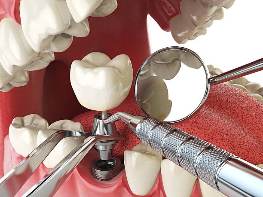 Tooth Extraction in Fort Worth: What You Need to Know