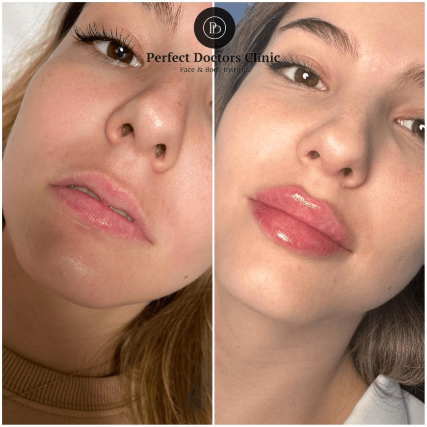 The Juvederm Filler Procedure: Step-by-Step Guide for Dubai Patients