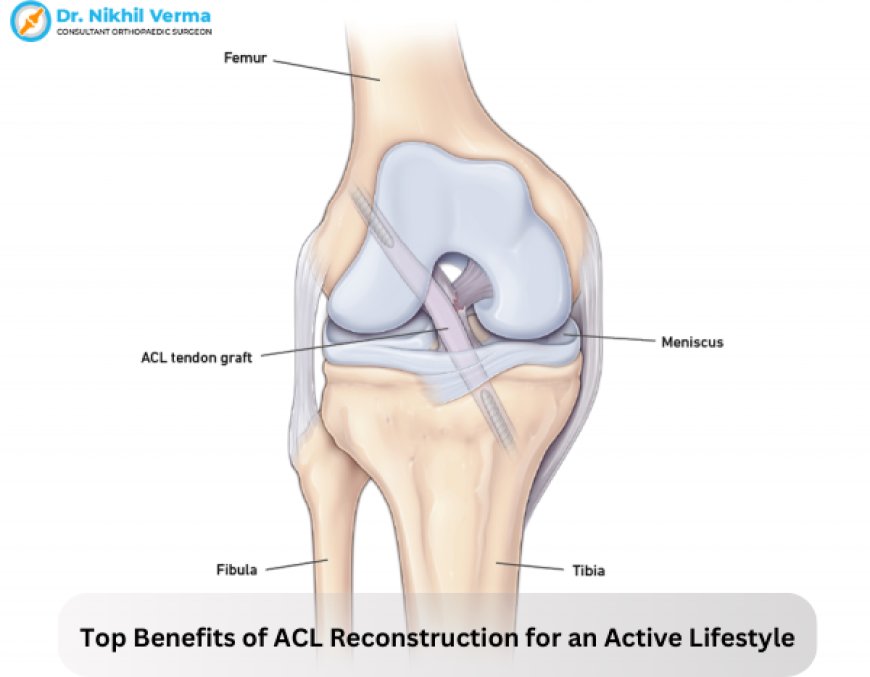 Top Benefits of ACL Reconstruction for an Active Lifestyle