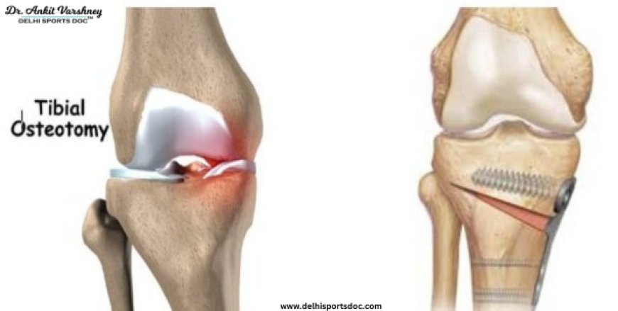 Understanding High Tibial Osteotomy for Knee Arthritis Relief