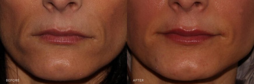 Discovering the Power of Sculptra and Profhilo Bio-Remodeling