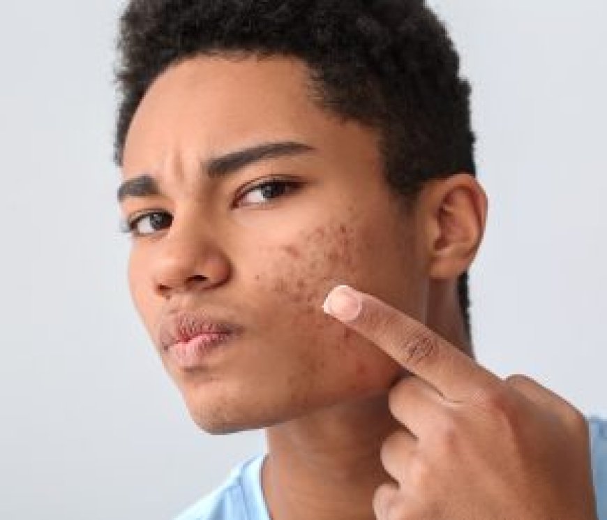 Is Acne Treatment Safe for Teenagers?