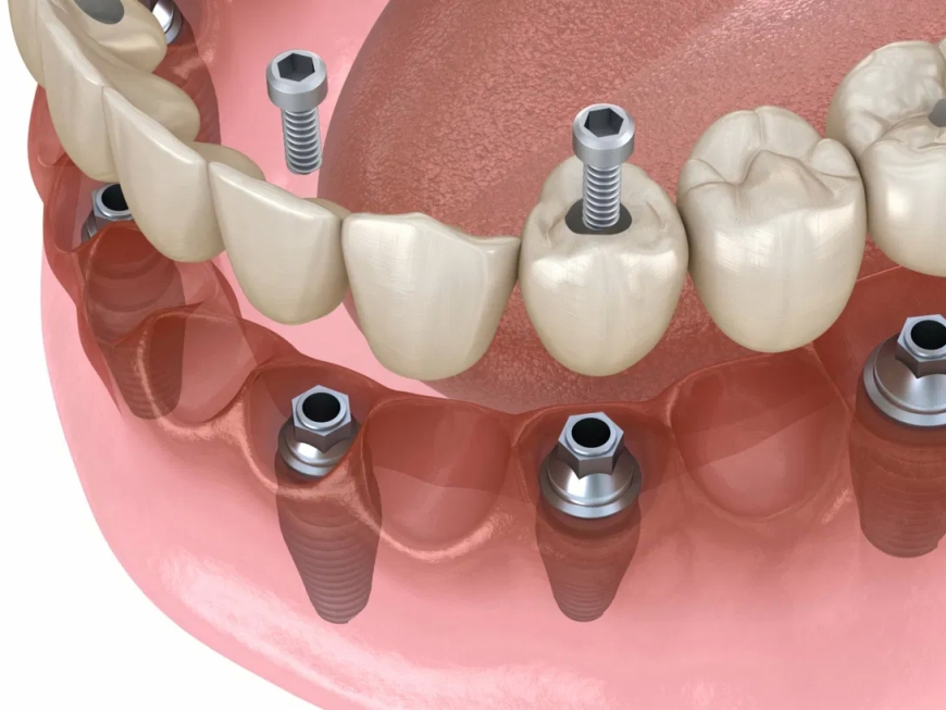 Dental Implants Fort Collins | Lasting Smile Solutions