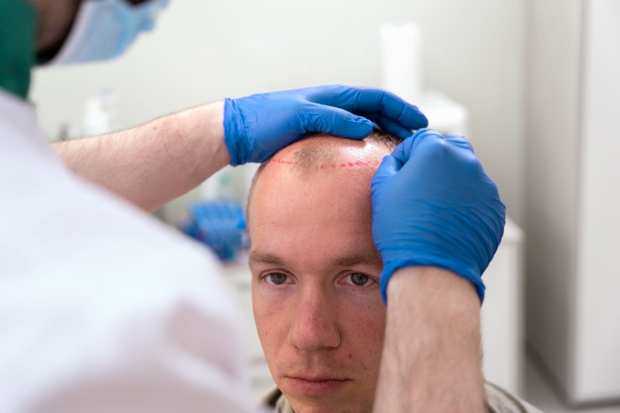 The Ultimate Guide to Choosing the Best Hair Transplant in Jaipur