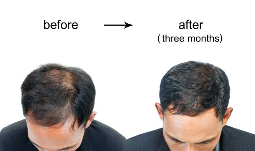 Hair Transplant Cost in Jaipur: How to Choose the Best Clinic for You