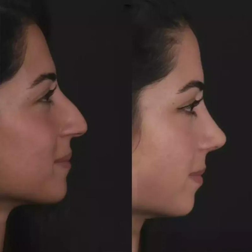 Why You Should Choose the Best Rhinoplasty Surgeon in Dubai for Your Procedure