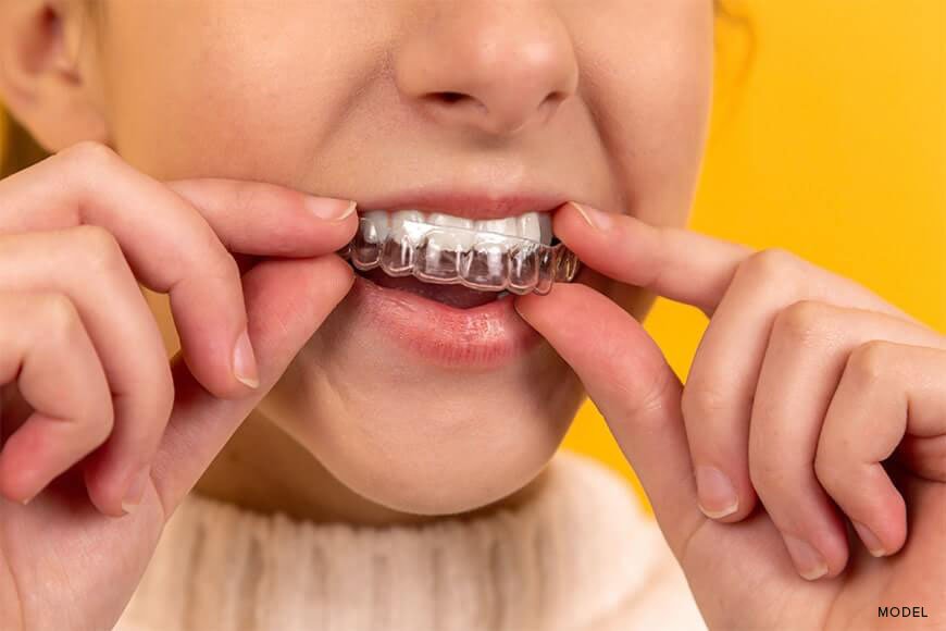 Invisalign for Teens: Features and Benefits