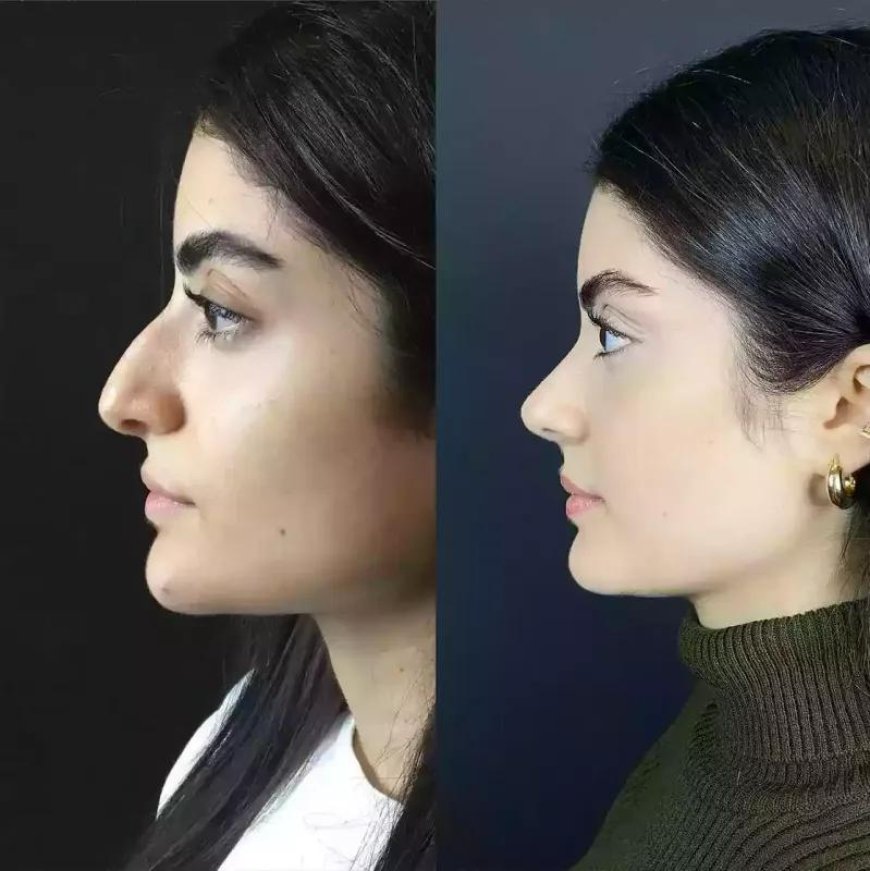 Best Doctors in Dubai for Rhinoplasty: Expert Care and Precision