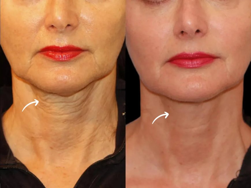 "Best Aesthetic Clinic in Dubai for Youthful   Sculptra Results"