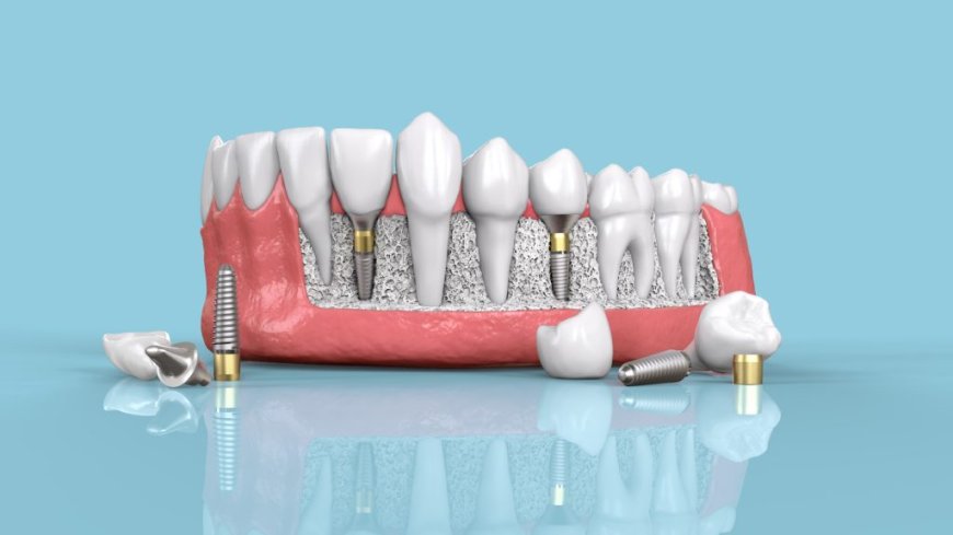 Okotoks Dental Implants: How They Impact Daily Life and Oral Health