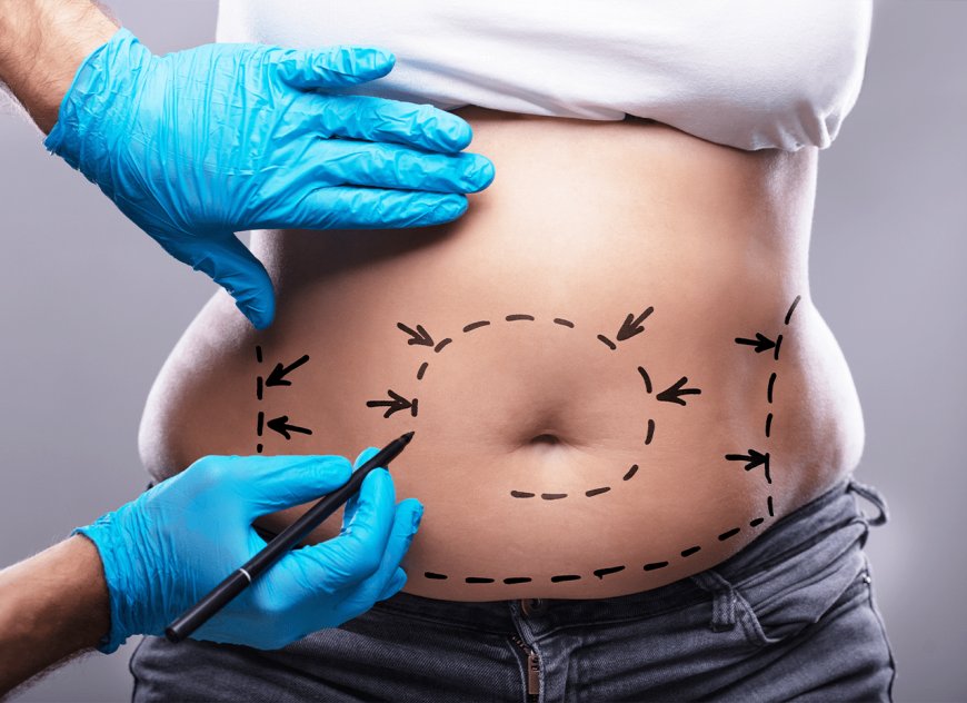 How Much Does Liposuction Cost in Dubai? Breaking Down the Factors