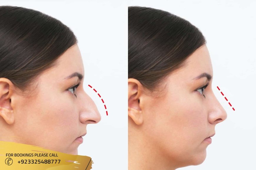 Top Qualities of the Best Rhinoplasty Surgeons in Islamabad