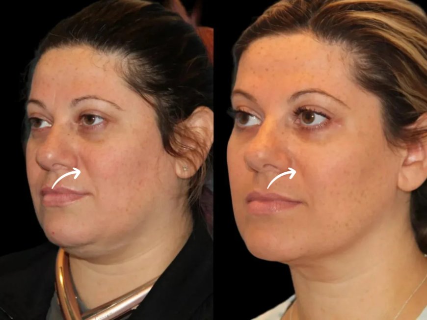 Best Aesthetic Clinics in dubai Explain How Sculptra Can Revitalize Your Skin