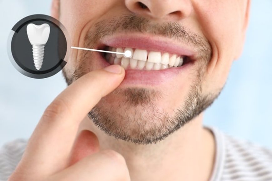 Are There Any Side Effects of Getting Dental Implants?