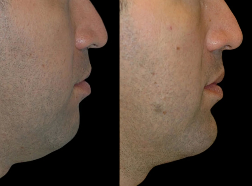 Addressing Common Concerns: Best Aesthetics Clinic in Dubai for Chin Fillers