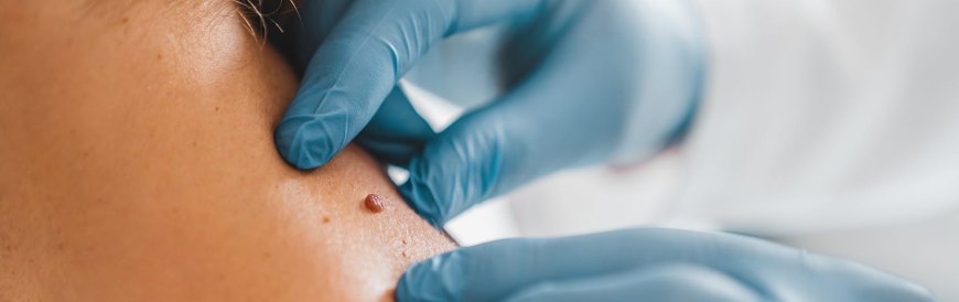 Top Clinics for Skin Tag Removal in Bangalore: Services and Costs Compared