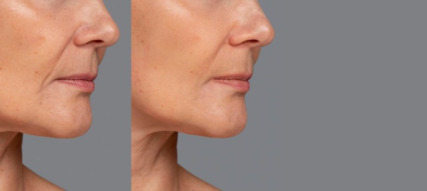 What Are the Results of 20 Units of Botox Before and After Treatment?