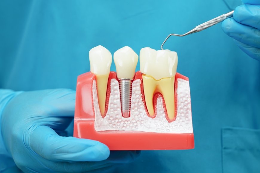 How Dental Implants Can Transform Your Smile and Confidence