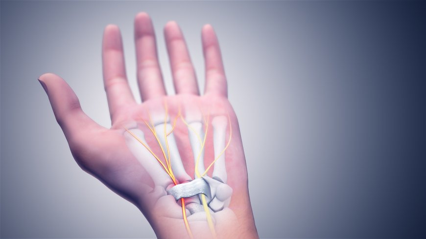 Is Surgery Necessary for Carpal Tunnel Syndrome in Lahore?