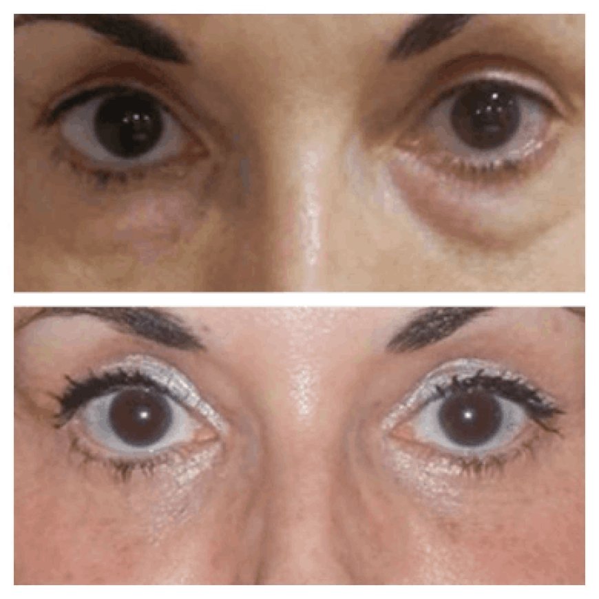 The Best Eye Bag Removal Surgeon in dubai: What to Look For