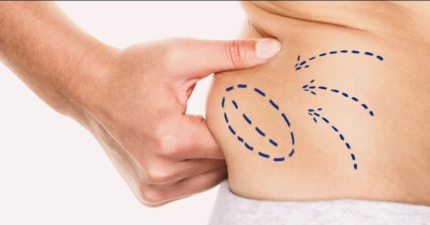 Understanding the Recovery Process for Stomach Liposuction in Dubai