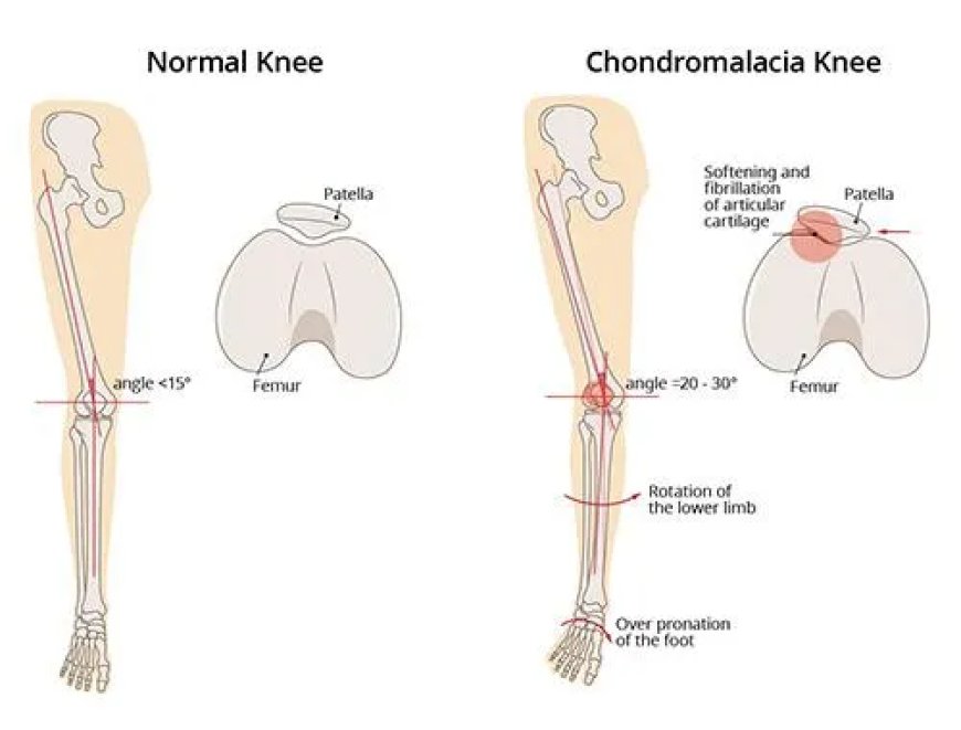 Reclaim Your Run: Progressive Specialists Proven Strategies for Overcoming Runner’s Knee and Restoring Mobility