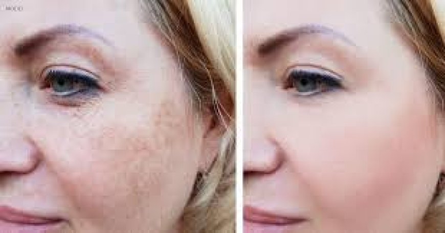 Achieve Flawless Skin with Laser Treatments for Hyperpigmentation