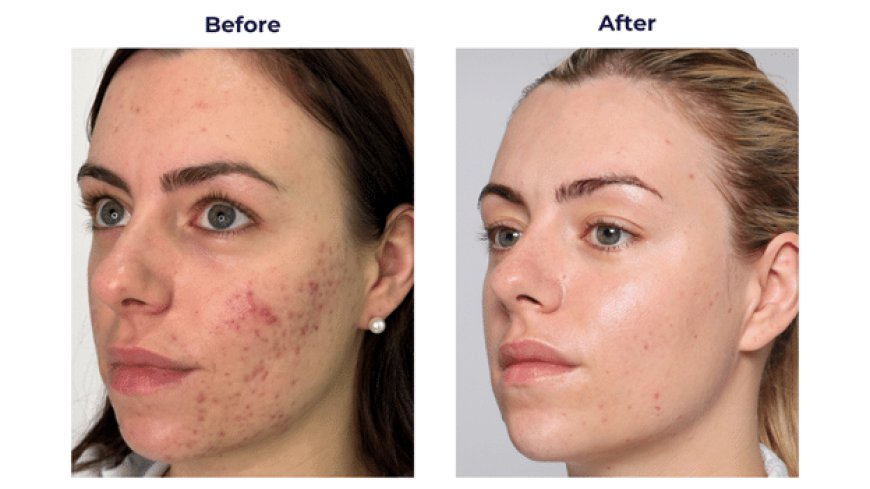 Advanced Solutions for Flawless Skin: Scar Laser Treatment and Non-Surgical Tightening