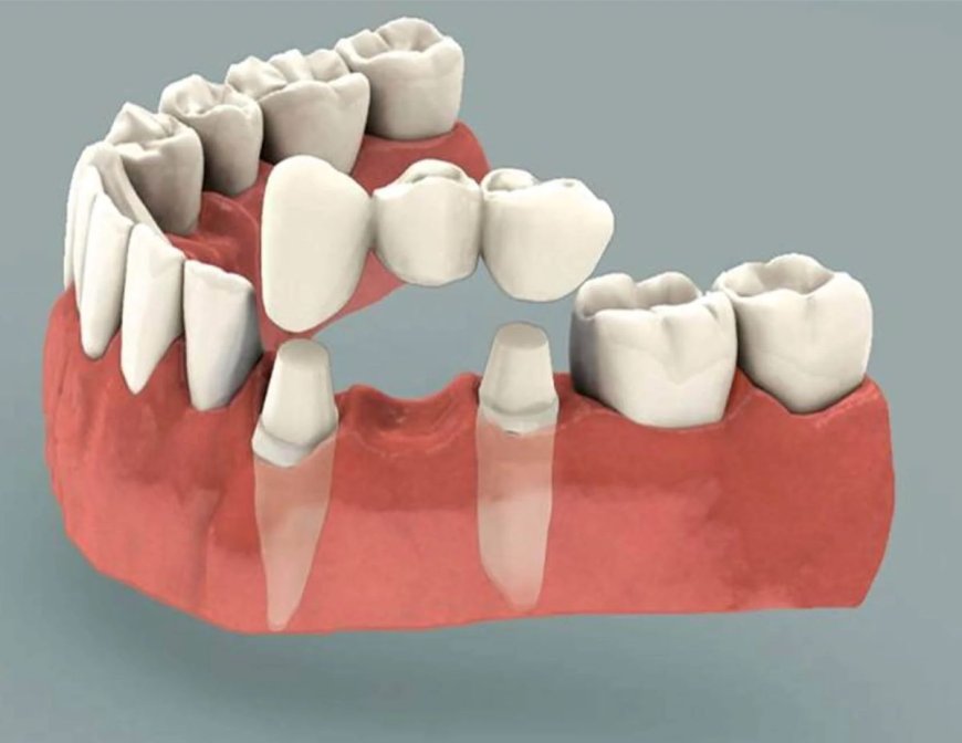 Are You Tired of Gaps in Your Teeth? Teeth with Bridges Could Be the Solution!