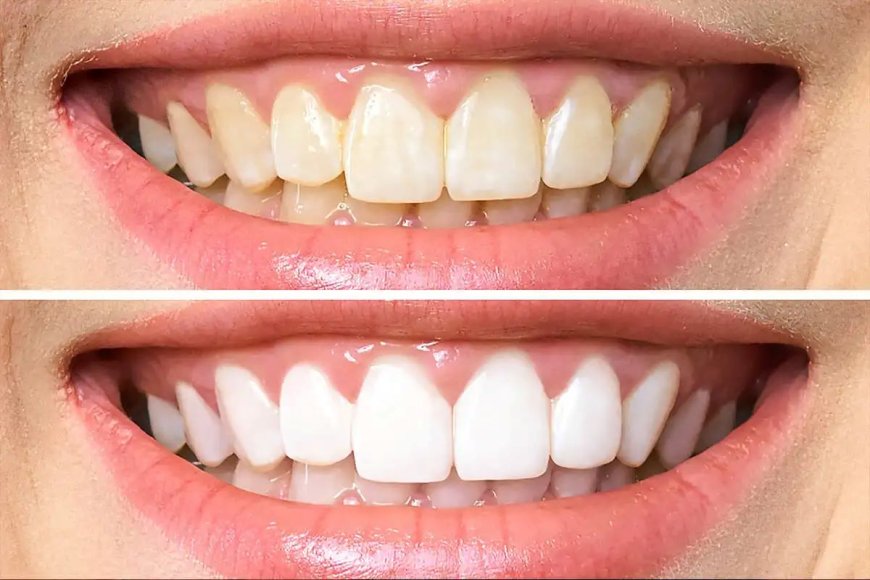 How Teeth Whitening Services in Nampa, ID, Use Advanced Technology for Guaranteed Results