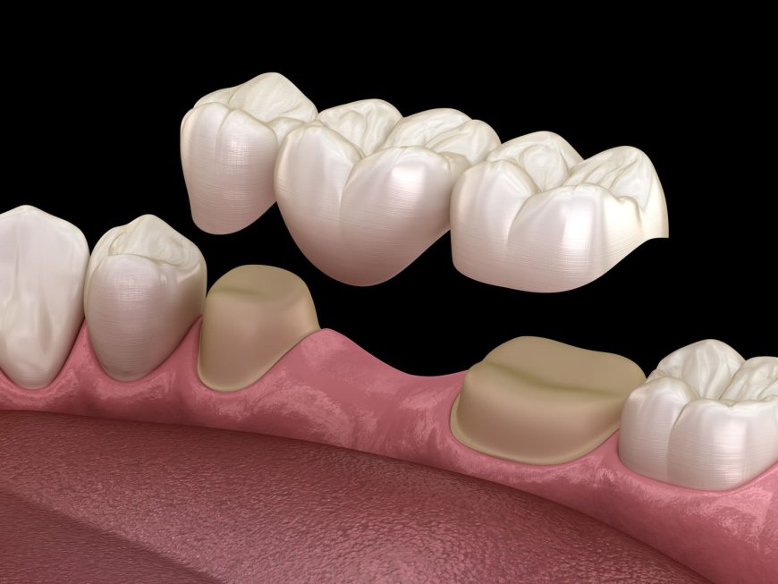 Braces or Dental Bridge for Front Teeth? The Answer Might Surprise You