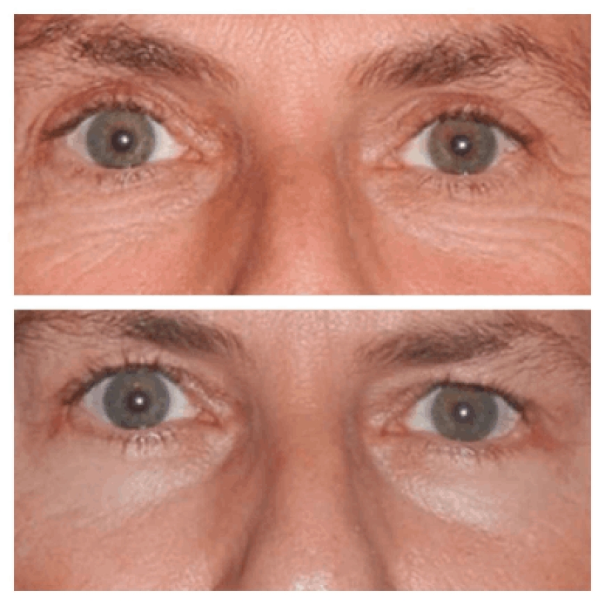 What Makes the Best Doctors in Dubai Trusted Experts in Eye Bag Removal?