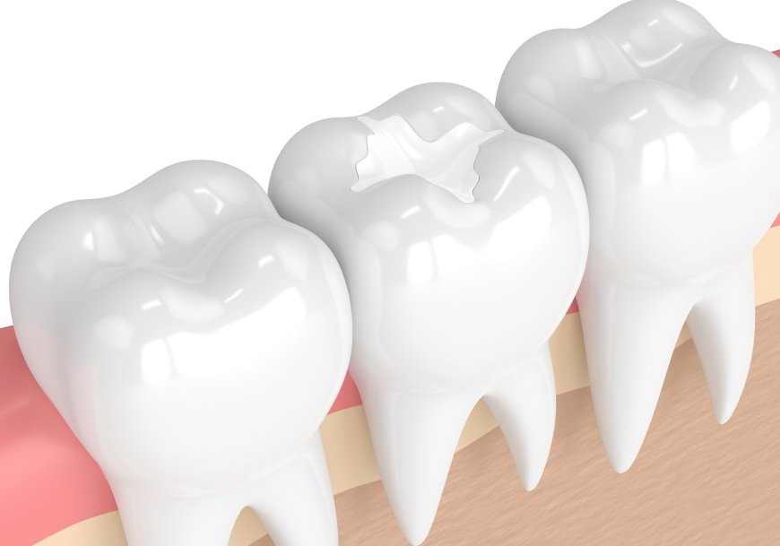 Fix Front Teeth Cavity Fillings in Billings, MT in Just One Visit