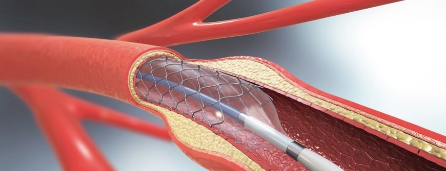 Europe Aortic Stent Graft Market,  Growth, Market Size,  Outlook | 2024-2032