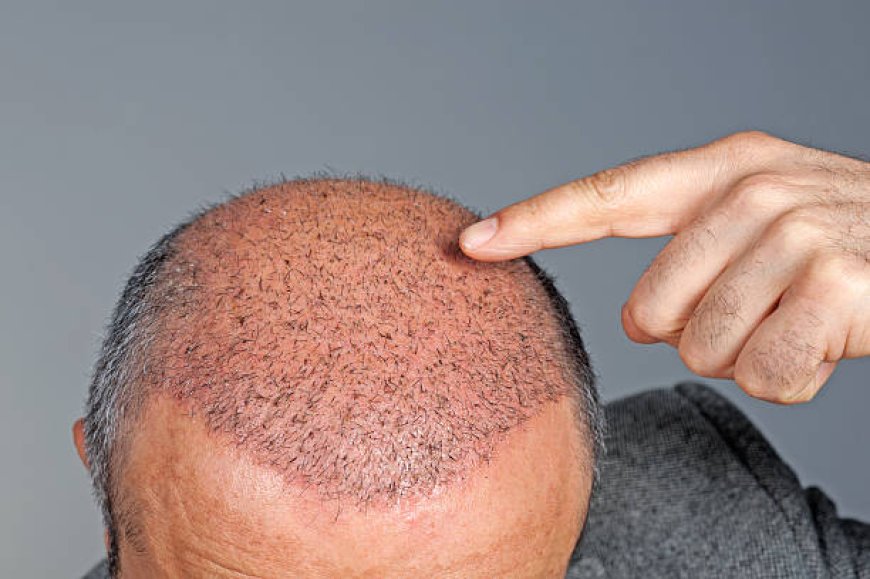 Best hair transplant center success rate in Pakistan