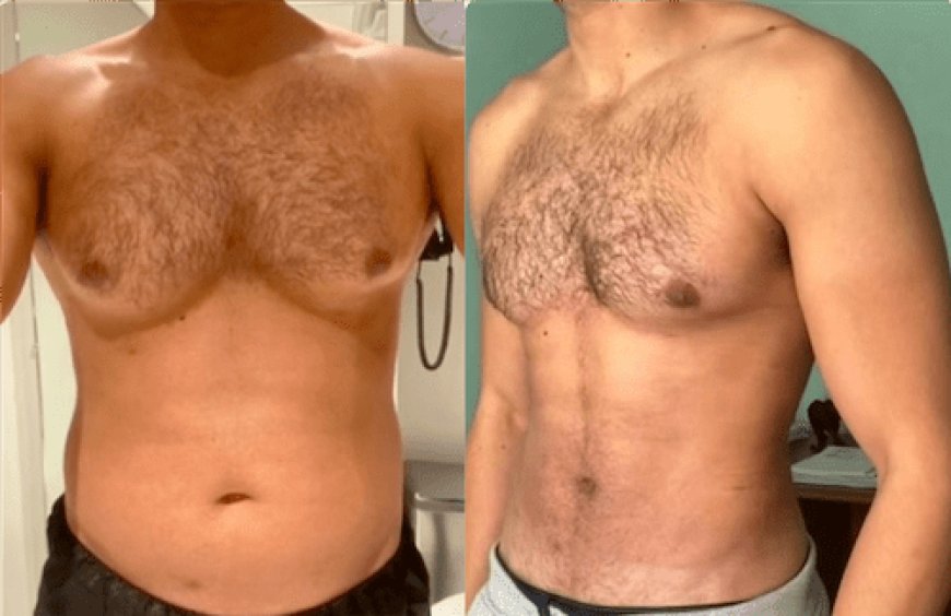 Gynecomastia Surgery in Dubai: Benefits, Cost, and Recovery